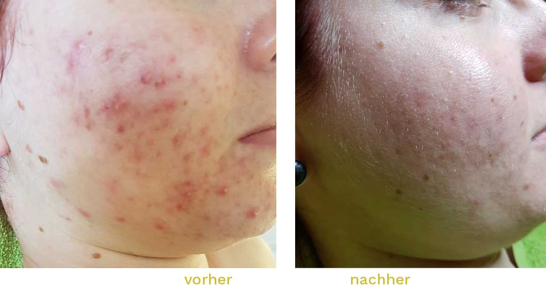 Akne-behandeln-kosmetik-pflege